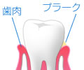 歯周病とは01